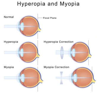 Hyperopia and Myopia
